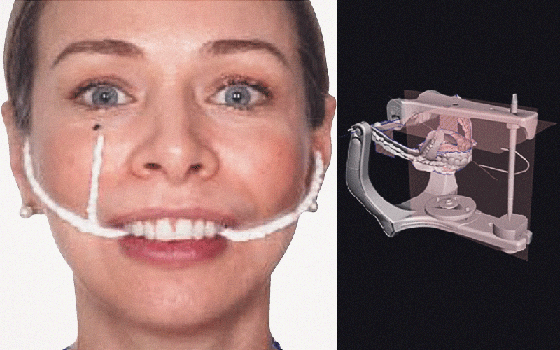 A técnica do Arco de Nicole utiliza apenas um scanner intraoral já disponível no consultório, um arco facial impresso em PLA com custo médio de R$ 50,00 e um software gratuito